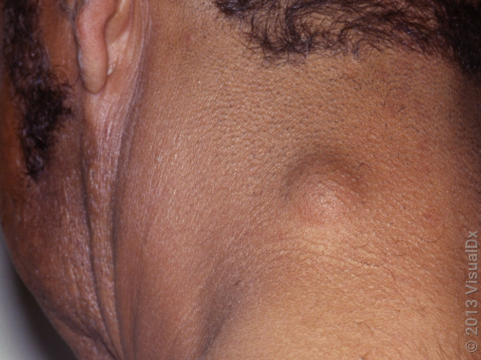 Sebaceous Cyst